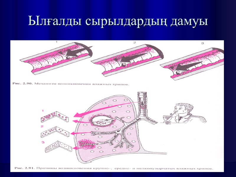 Ылғалды сырылдардың дамуы